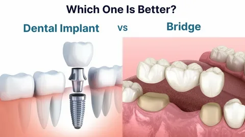Dental Implants Manchester