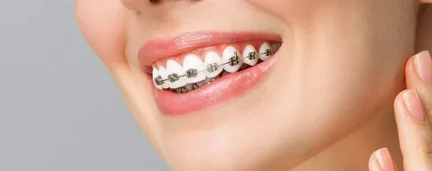 fixed braces Manchester