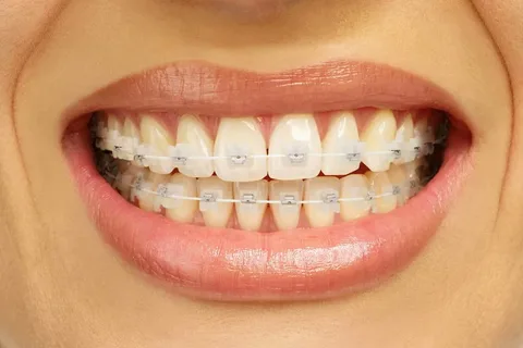 fixed braces Manchester